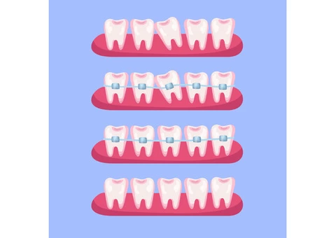 Orthodontics: The Different Types Of Orthodontic Treatment