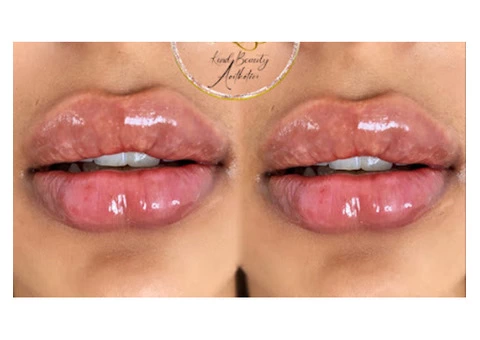 Best Lip Fillers in Leamore
