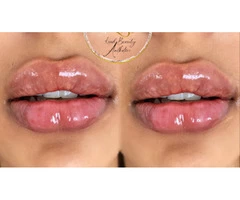 Best Lip Fillers in Leamore
