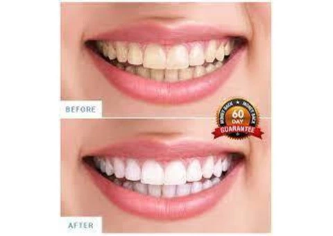 Cleaner Smile Teeth Whitening Kit - 2/3