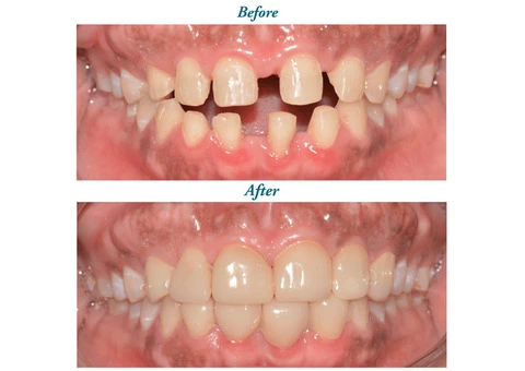 Restore Your Smile with Dental Implant Surrey