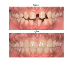 Restore Your Smile with Dental Implant Surrey