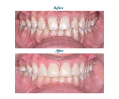 Permanent Solution for Missing Teeth-done