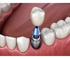 Experience the Best Dental Implant Service in Surrey