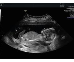 Capture the precious moments with a Private 4D Baby Scan.