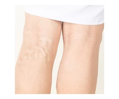 Varicose Veins Treatment in the UK With SASVTC