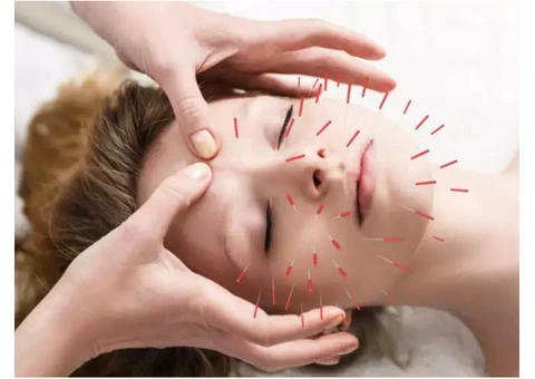 Unlock Your Body's Natural Healing Potential With Acupuncture Treatment In London