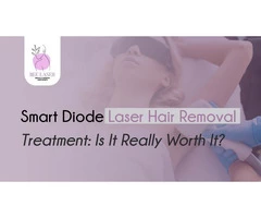 Smart Diode Laser Hair Removal Treatment: Is Really Worth It?