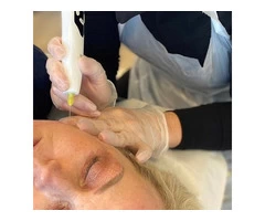 Laser Pigmentation Removal in Chester