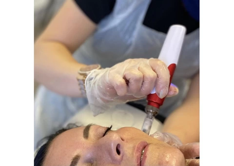 Microneedling Treatment in Chester