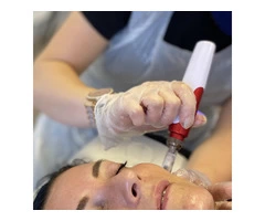 Microneedling Treatment in Chester