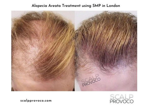 Scalp Provoco - 1/7