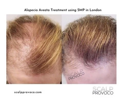 Scalp Provoco