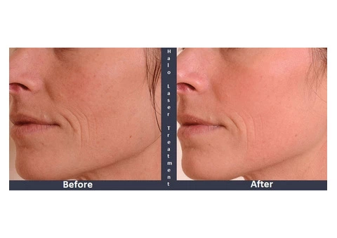 The Transformative Power of Halo Laser Treatment