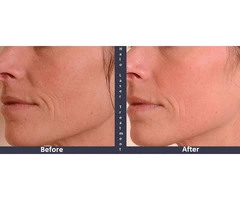 The Transformative Power of Halo Laser Treatment