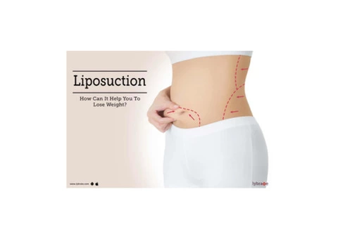 Liposuction