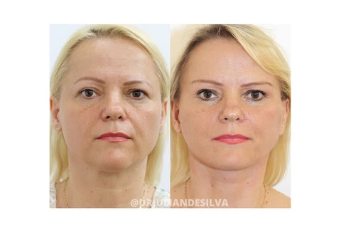 The Centre for Advanced Facial Cosmetic and Plastic Surgery: Dr Julian de Silva - 1/5