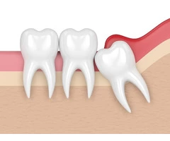 Wisdom Tooth Extraction, Wisdom Teeth Removal in Glastonbury, CT