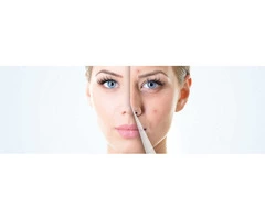 Get Clear Looking Skin with Acne Treatments Wembley - DSL Clinic