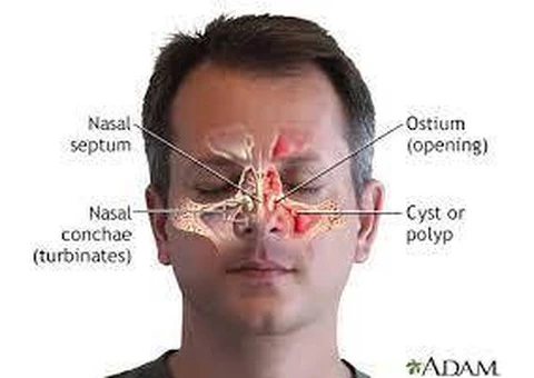 Sinus infection – What is, Types & Best Treatment for It