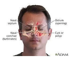 Sinus infection – What is, Types & Best Treatment for It