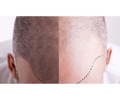 Hair Fall Solution In Exeter