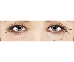 Functional Eyelid Surgery in London by Dr Pari Shams