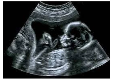 Find Peace of Mind with Reassurance Scans in Peterborough at Window To The Womb