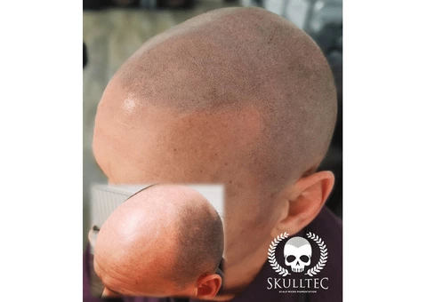 Scalp Micropigmentation in Kent
