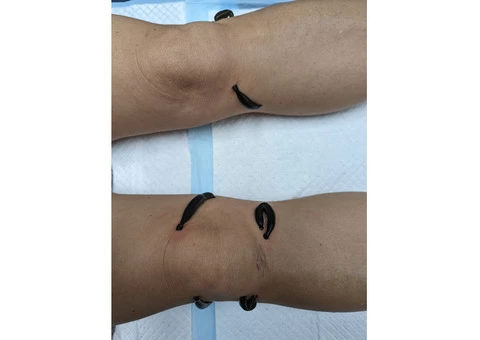 Hirudotherapy. Best way to be healthy and Ideal cosmetology treatment! - 7/8