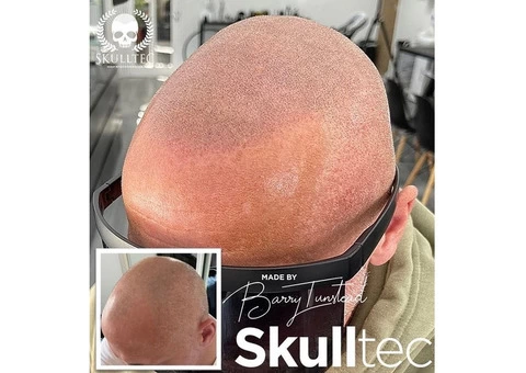 Scalp Micropigmentation in London