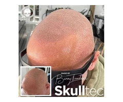 Scalp Micropigmentation in London