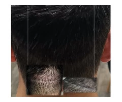 Scalp Micropigmentation For Scars (FUT & FUE)