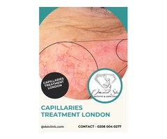 Capillaries Treatment in London