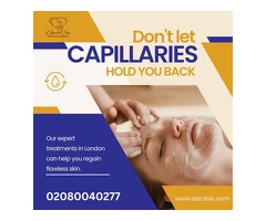 Capillaries Treatment in London
