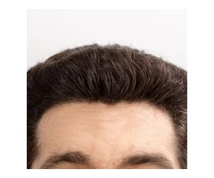 SMP For Hairline Restoration