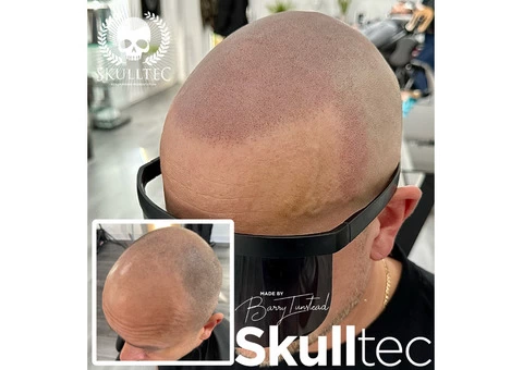 Scalp Micropigmentation in Glasgow - 1/3