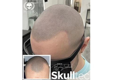 Scalp Micropigmentation in Glasgow - 2/3