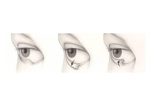 Make Call To Dr Pari Shams For Ectropion Repair