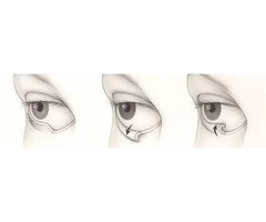 Make Call To Dr Pari Shams For Ectropion Repair