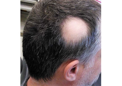 SMP For Alopecia