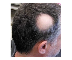 SMP For Alopecia