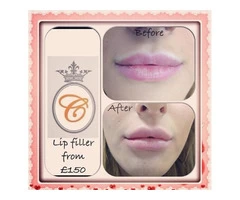 Best Botox and Lip Filler in Leeds