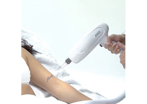 Laser Tattoo Removal