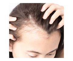 Best Perimenopausal Hair Loss Solution