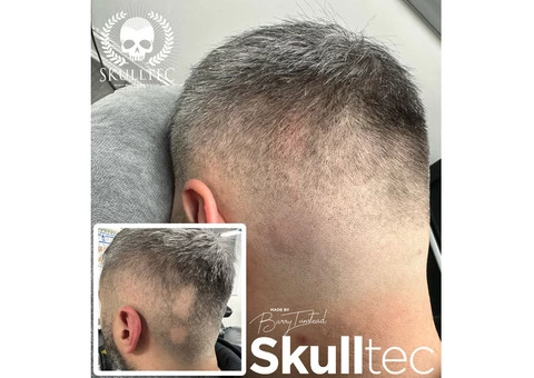 Scar Camouflage With Scalp Micropigmentation