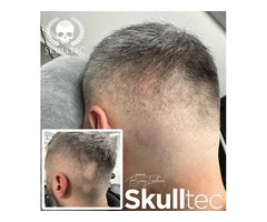 Scar Camouflage With Scalp Micropigmentation