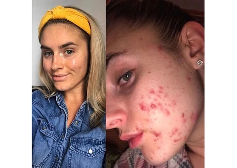 Natural Radiance Awaits: Top Acne Treatments in Merseyside!