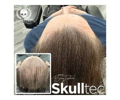 Scalp Micropigmentation For Long Hair