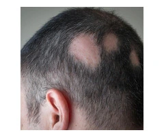 Hormonal Hair Loss Solution in Scotland